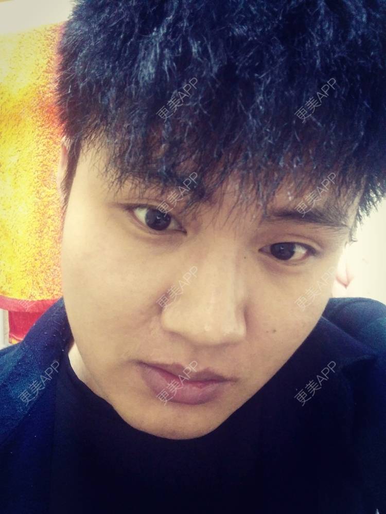 更美 - Wyl-.-的双眼皮经验 | 双眼皮 | 南昌