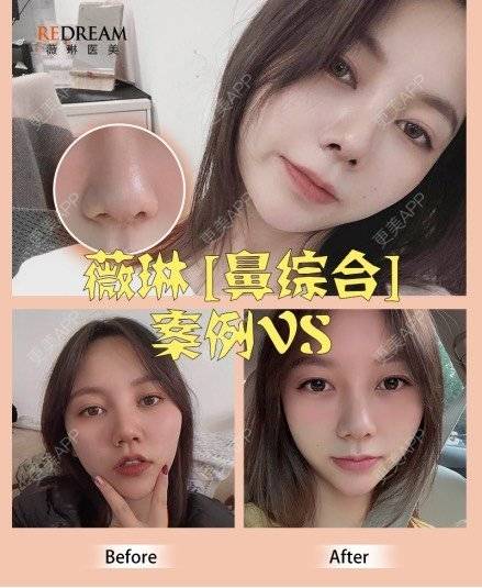 更美 - 顾陆健 医生的鼻部多项经验 | 鼻部多项 | 苏州