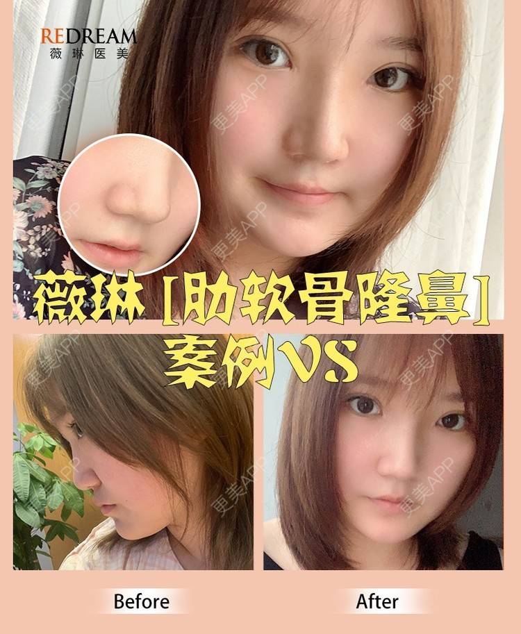 更美 - 顾陆健 医生的鼻部多项经验 | 鼻部多项 | 苏州