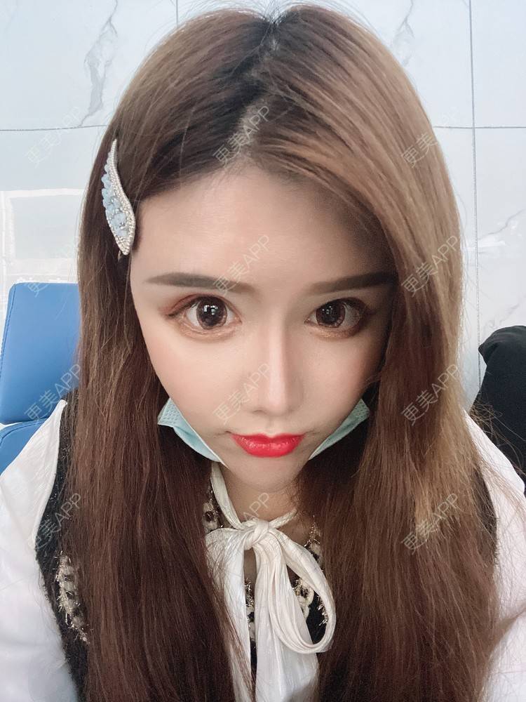 更美 - A.🌸大媛的肋软骨隆鼻经验 | 肋软骨隆鼻 | 郑州