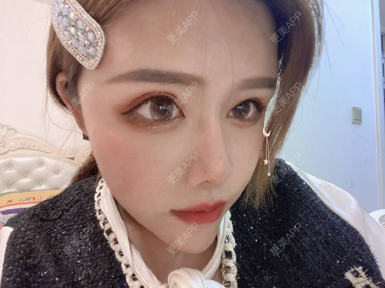 更美 - A.🌸大媛的肋软骨隆鼻经验 | 肋软骨隆鼻 | 郑州