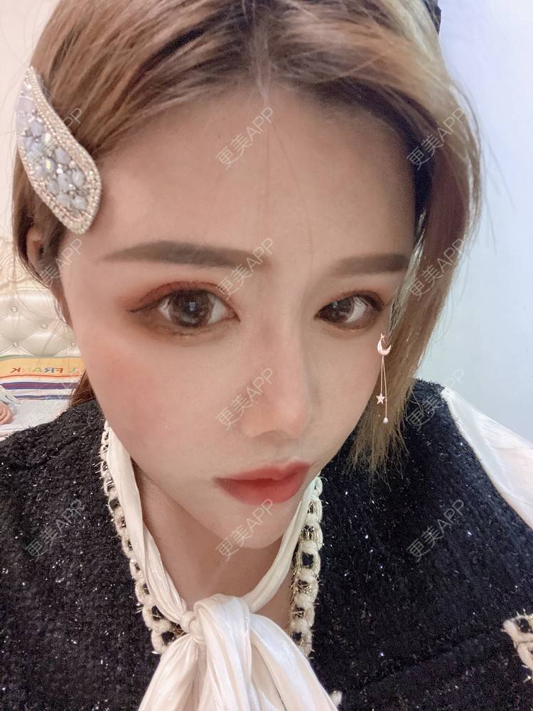 更美 - A.🌸大媛的肋软骨隆鼻经验 | 肋软骨隆鼻 | 郑州