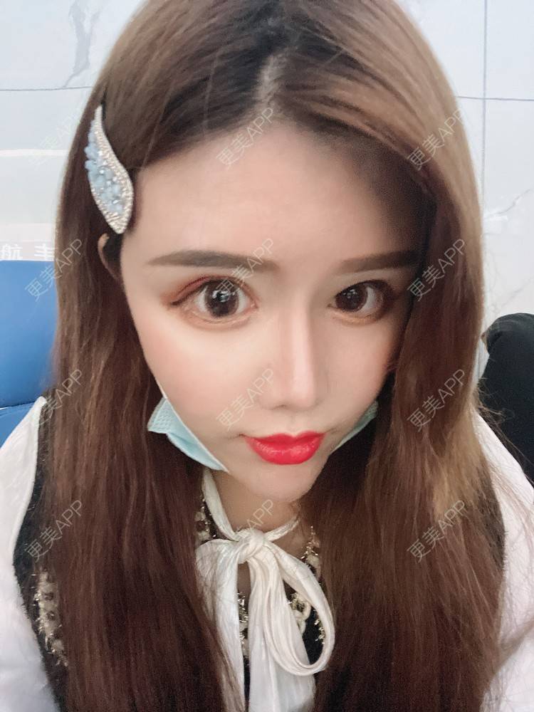 更美 - A.🌸大媛的肋软骨隆鼻经验 | 肋软骨隆鼻 | 郑州