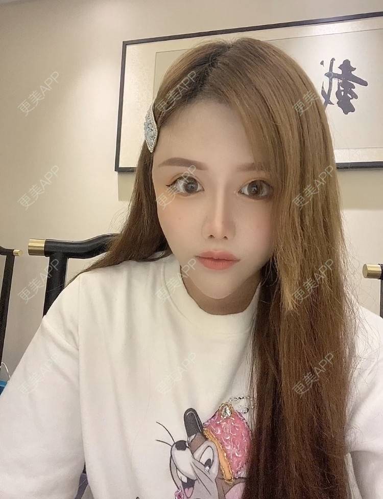 更美 - A.🌸大媛的肋软骨隆鼻经验 | 肋软骨隆鼻 | 郑州