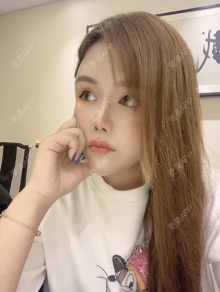 更美 - A.🌸大媛的肋软骨隆鼻经验 | 肋软骨隆鼻 | 郑州