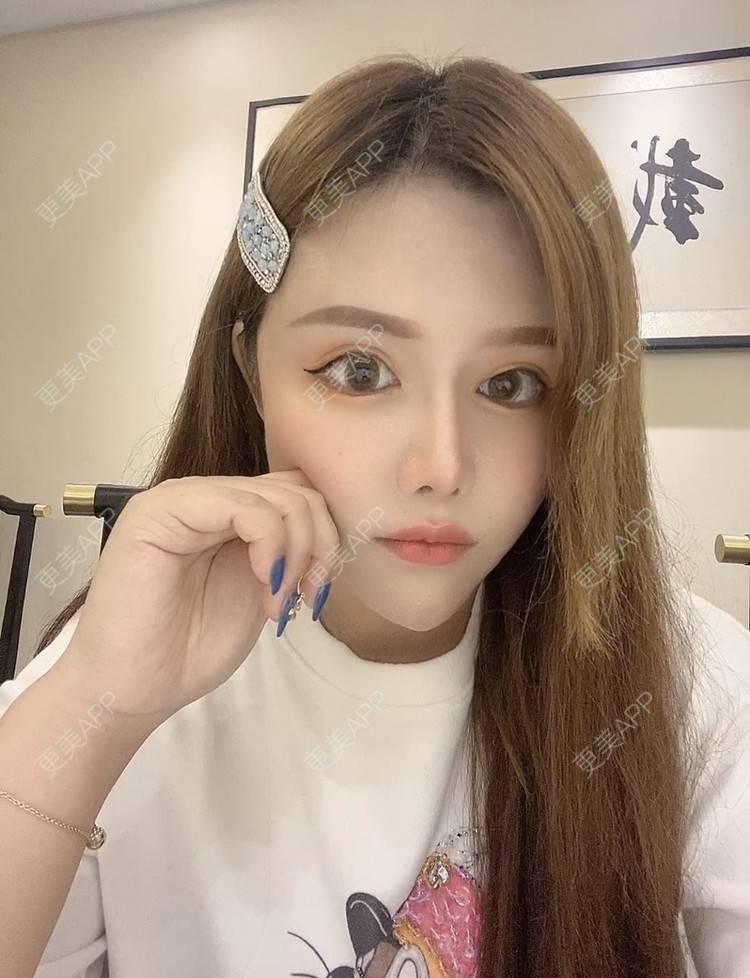 更美 - A.🌸大媛的肋软骨隆鼻经验 | 肋软骨隆鼻 | 郑州