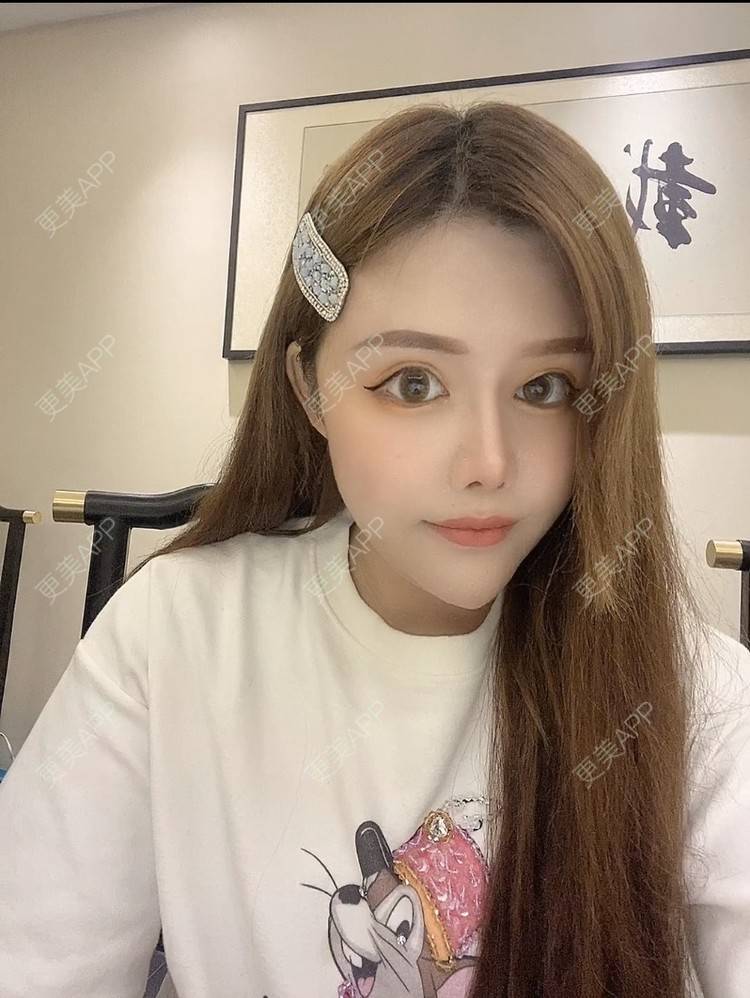 更美 - A.🌸大媛的肋软骨隆鼻经验 | 肋软骨隆鼻 | 郑州