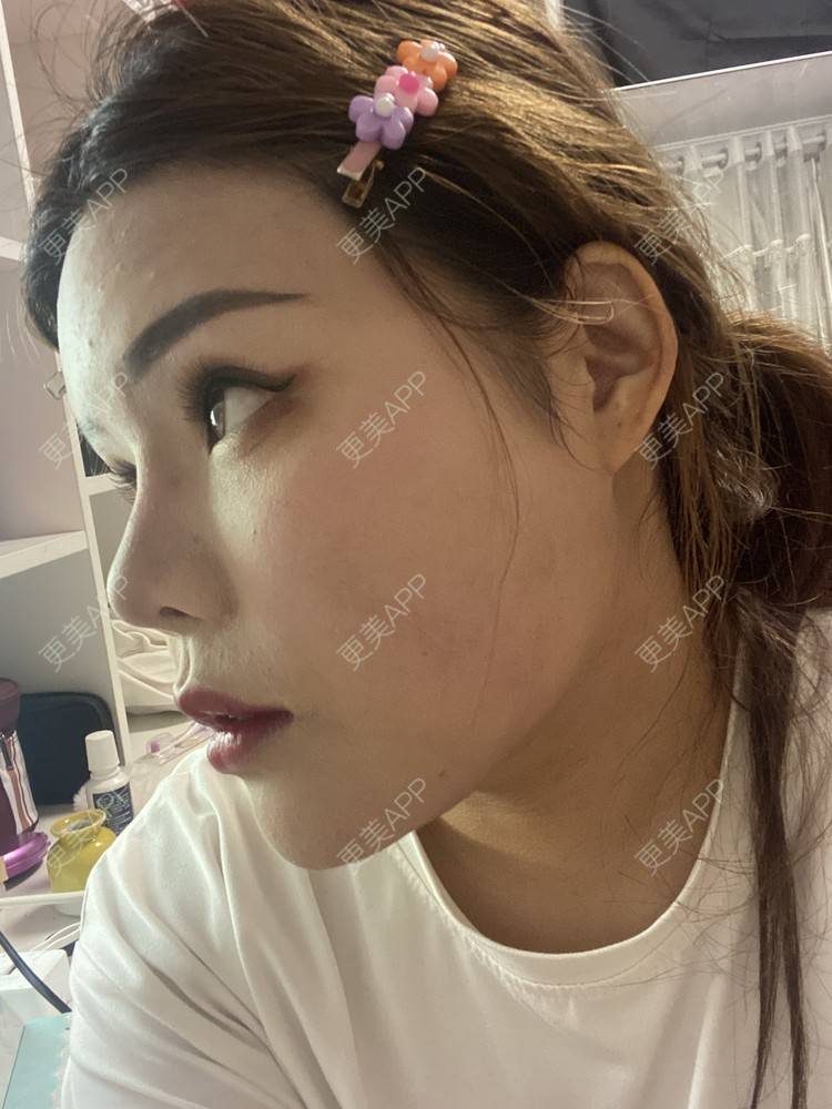 更美 - A.🌸大媛的肋软骨隆鼻经验 | 肋软骨隆鼻 | 郑州