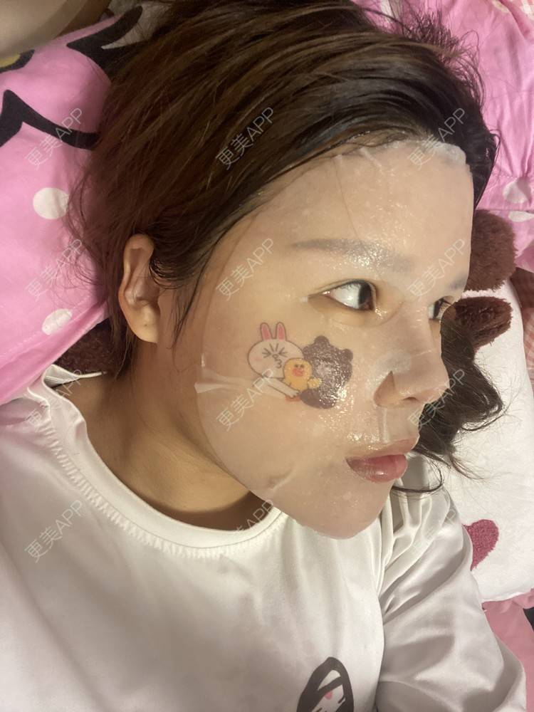 更美 - A.🌸大媛的肋软骨隆鼻经验 | 肋软骨隆鼻 | 郑州