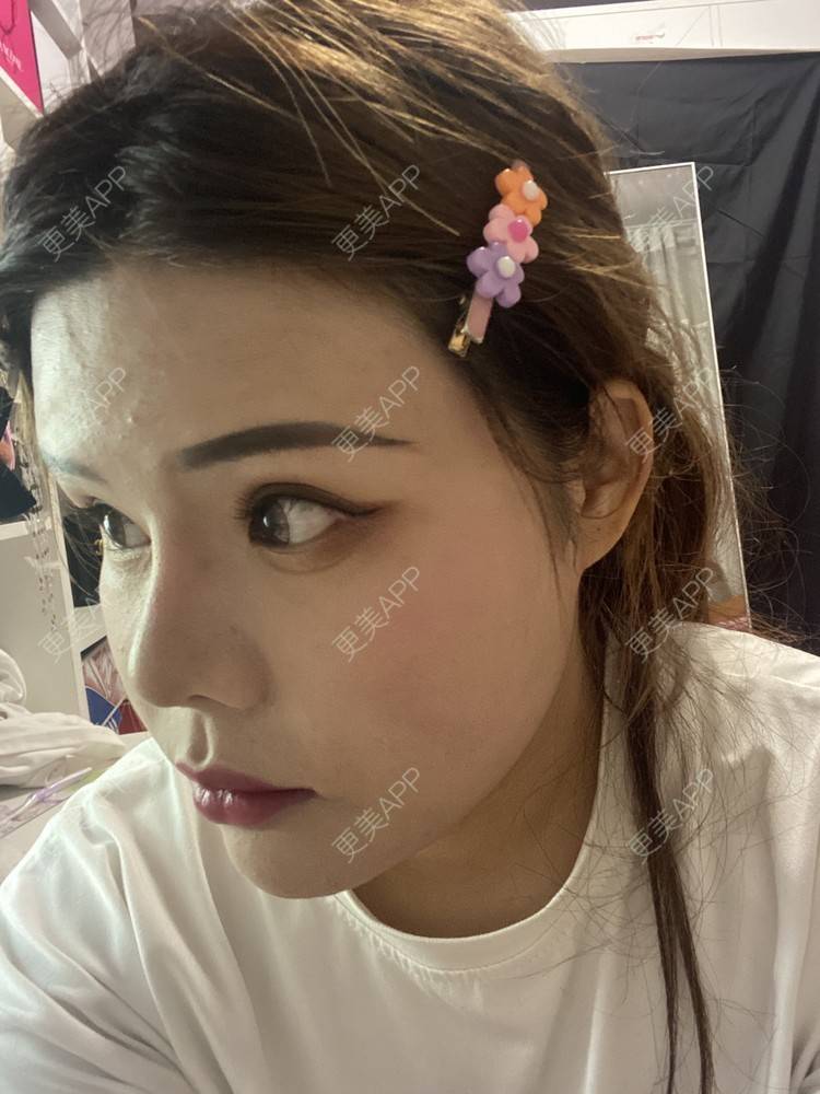 更美 - A.🌸大媛的肋软骨隆鼻经验 | 肋软骨隆鼻 | 郑州