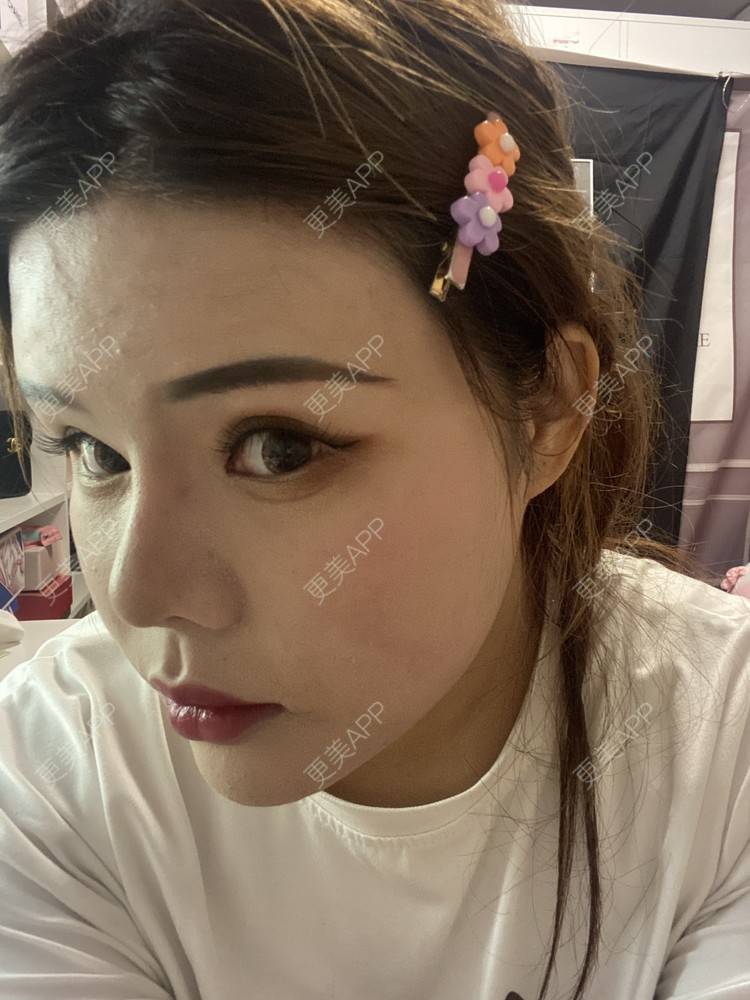 更美 - A.🌸大媛的肋软骨隆鼻经验 | 肋软骨隆鼻 | 郑州