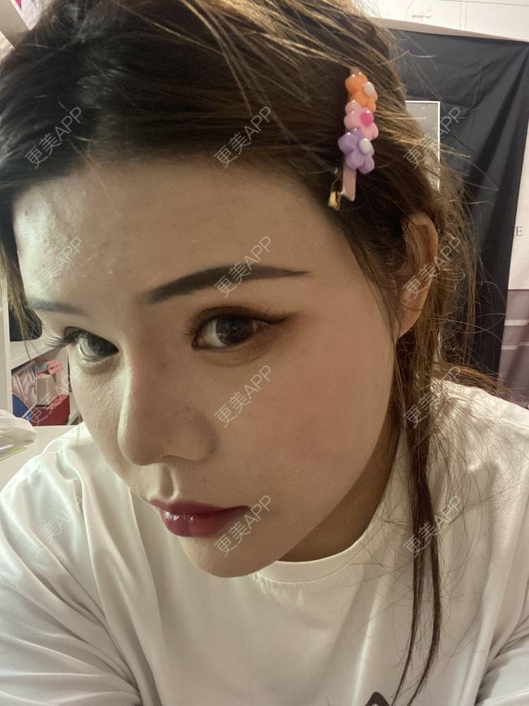 更美 - A.🌸大媛的肋软骨隆鼻经验 | 肋软骨隆鼻 | 郑州