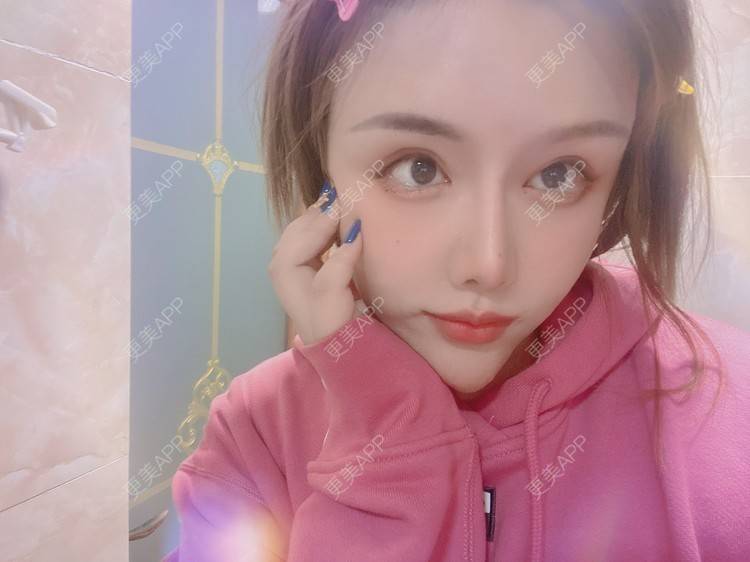 更美 - A.🌸大媛的肋软骨隆鼻经验 | 肋软骨隆鼻 | 郑州