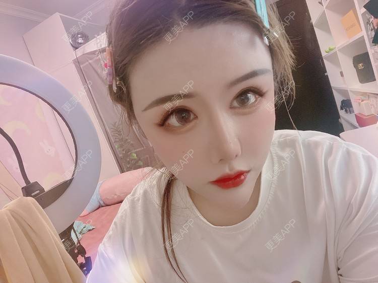 更美 - A.🌸大媛的肋软骨隆鼻经验 | 肋软骨隆鼻 | 郑州