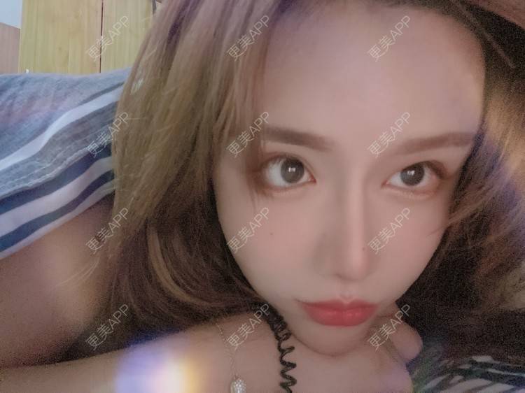 更美 - A.🌸大媛的肋软骨隆鼻经验 | 肋软骨隆鼻 | 郑州