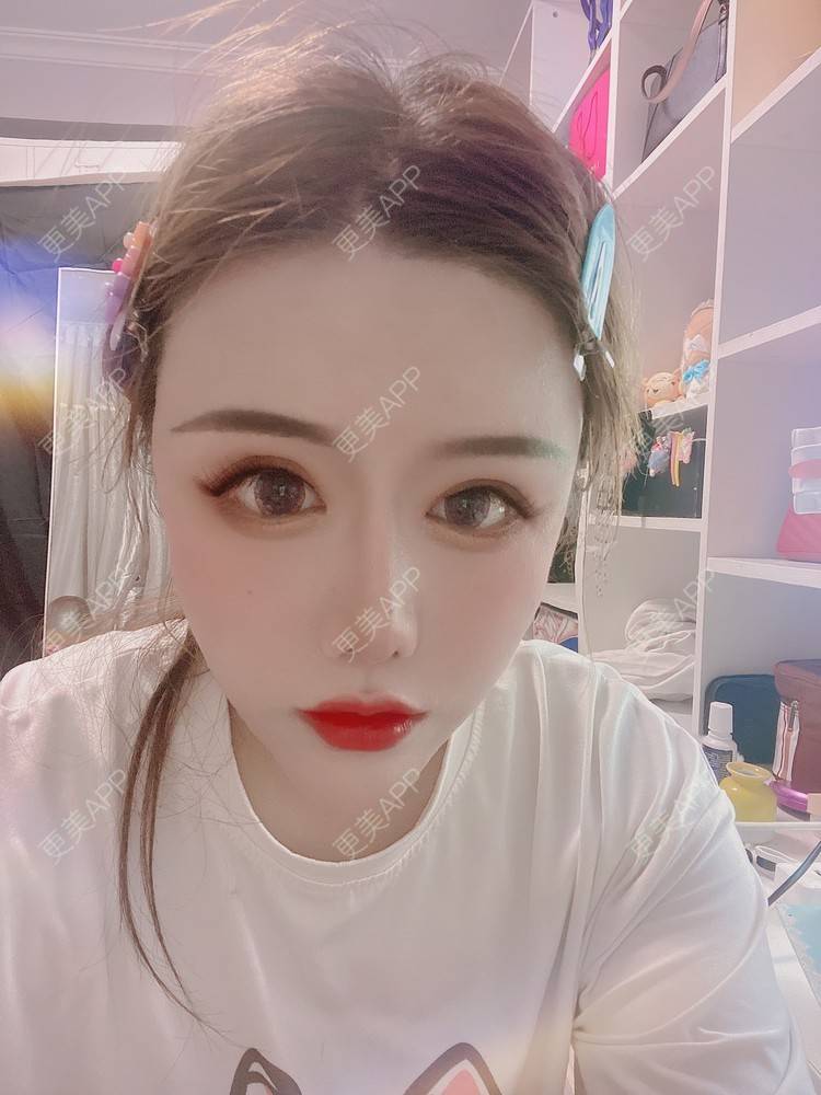 更美 - A.🌸大媛的肋软骨隆鼻经验 | 肋软骨隆鼻 | 郑州