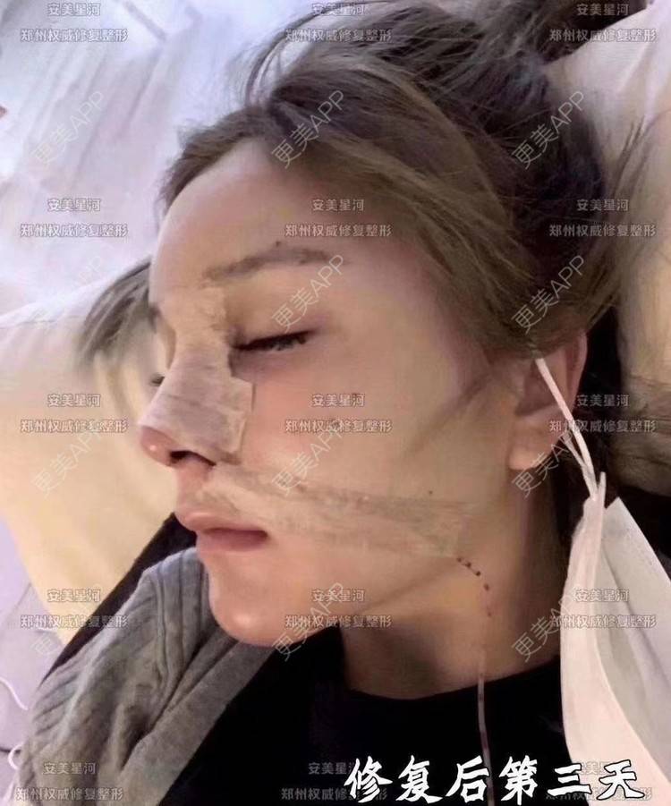 更美 - 郑州安美星河的鼻部膨体假体取出经验 | 鼻形态修复 | 鼻部膨体假体取出 | 鼻部硅胶假体取出 | 郑州