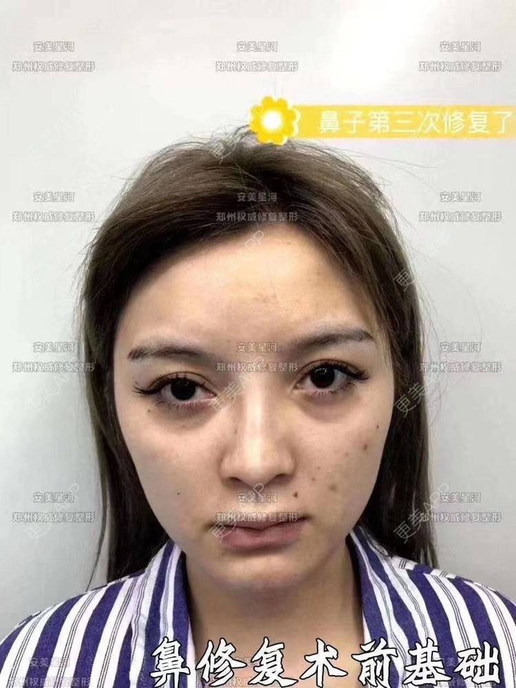 更美 - 郑州安美星河的鼻部膨体假体取出经验 | 鼻形态修复 | 鼻部膨体假体取出 | 鼻部硅胶假体取出 | 郑州