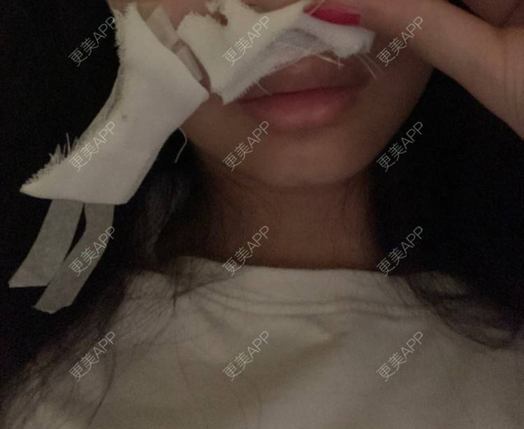 更美 - 更美用户8344550921的唇腭裂修复经验 | 唇腭裂修复 | 蚌埠