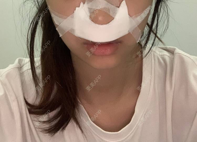 更美 - 更美用户8344550921的唇腭裂修复经验 | 唇腭裂修复 | 蚌埠