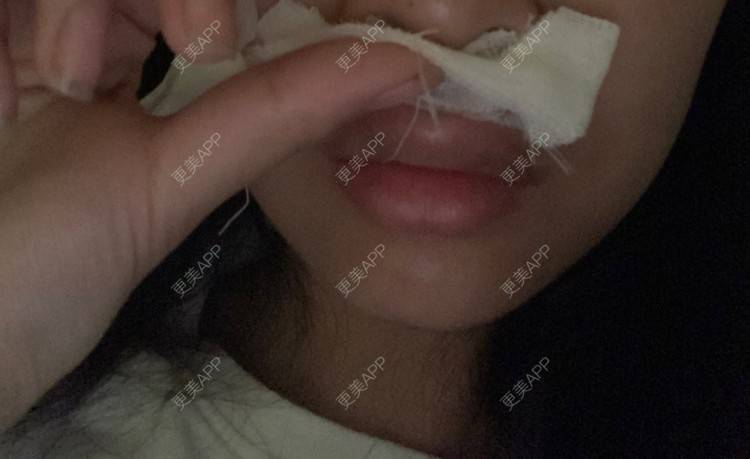 更美 - 更美用户8344550921的唇腭裂修复经验 | 唇腭裂修复 | 蚌埠