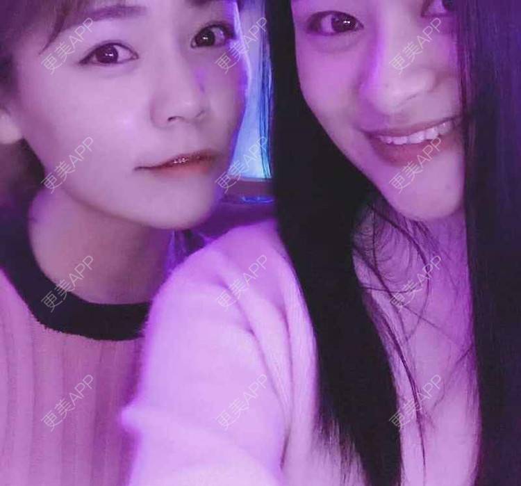 更美 - 爆炸666的自体脂肪填充泪沟经验 | 自体脂肪全面部填充 | 自体脂肪填充泪沟 | 自体脂肪丰苹果肌 | 自体脂肪垫下巴 | 自体脂肪丰太阳穴 | 自体脂肪丰额头