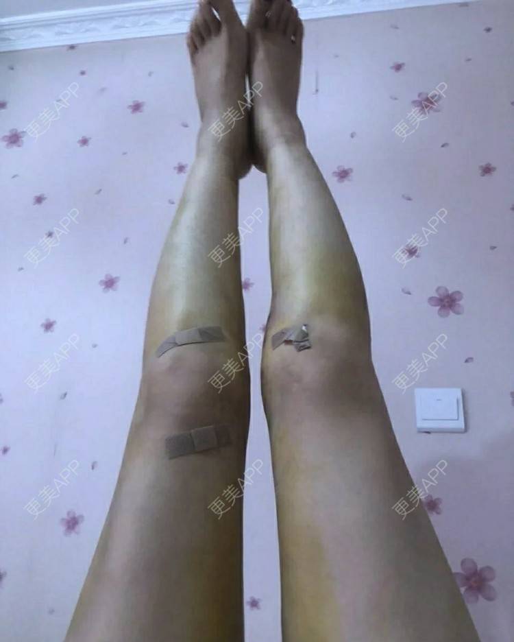 更美 - ┋霾瘾尐ηǚ┊却的吸脂瘦大腿经验 | 吸脂瘦大腿 | 武汉