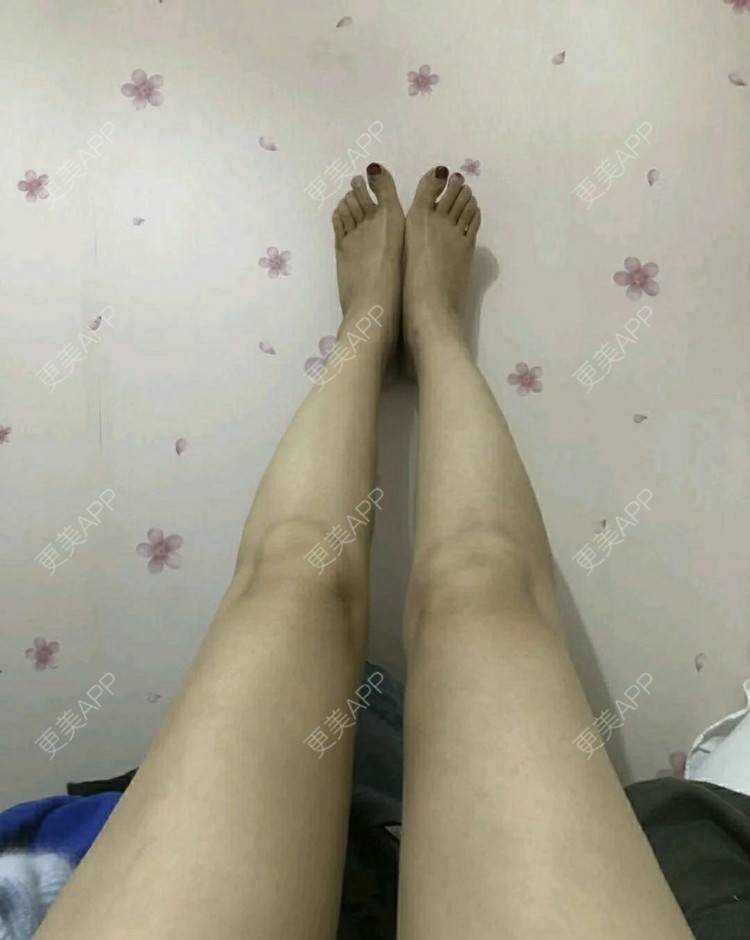 更美 - ┋霾瘾尐ηǚ┊却的吸脂瘦大腿经验 | 吸脂瘦大腿 | 武汉