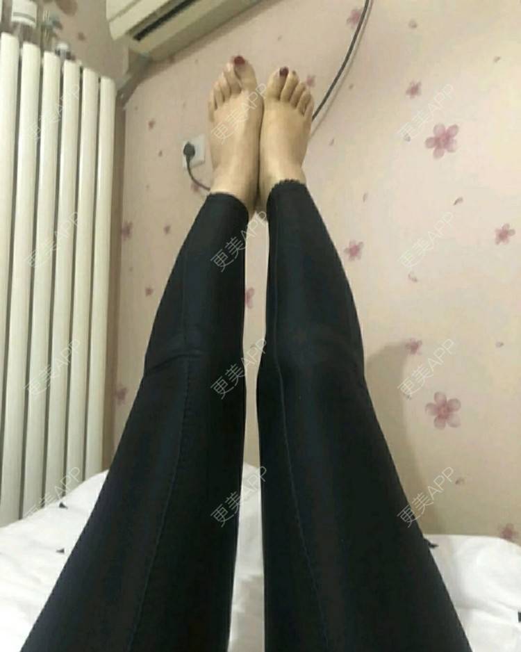 更美 - ┋霾瘾尐ηǚ┊却的吸脂瘦大腿经验 | 吸脂瘦大腿 | 武汉