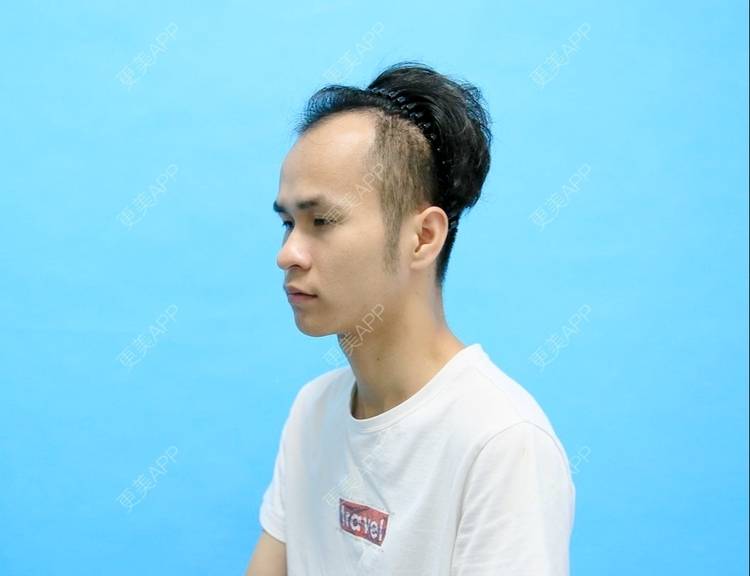 更美 - 更美用户P8KrUHueYa的植发际线经验 | 植发际线 | 毛发移植 | 北京