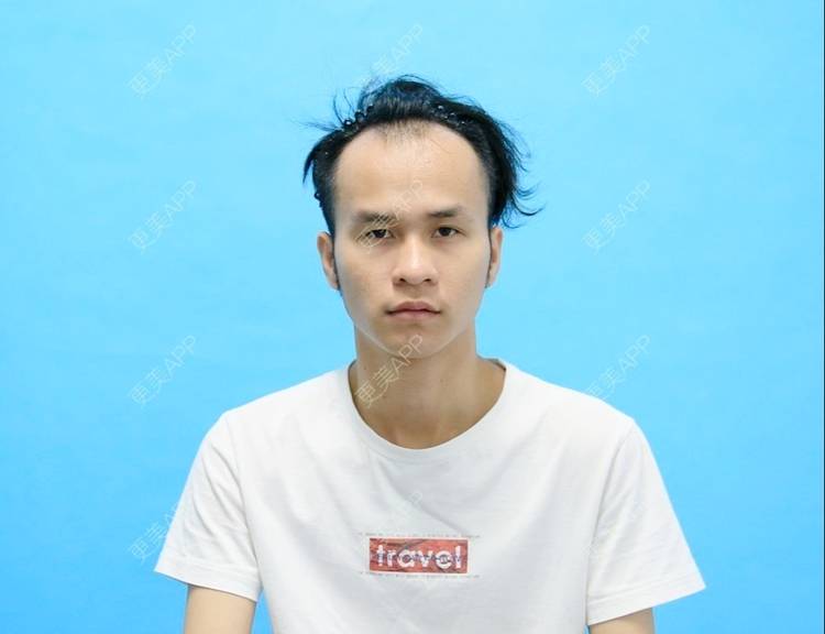 更美 - 更美用户P8KrUHueYa的植发际线经验 | 植发际线 | 毛发移植 | 北京