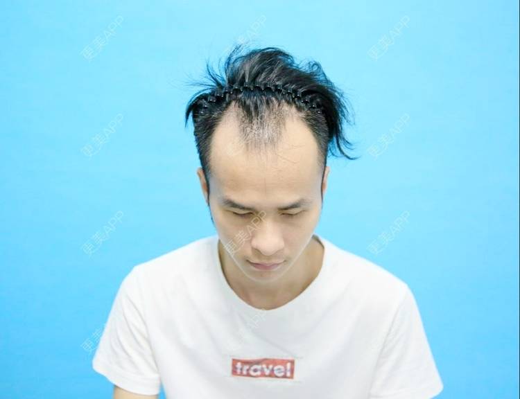 更美 - 更美用户P8KrUHueYa的植发际线经验 | 植发际线 | 毛发移植 | 北京