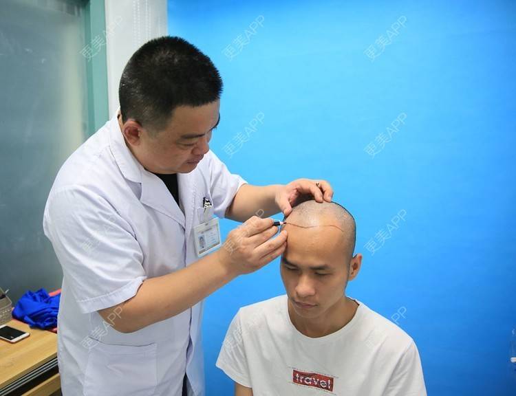 更美 - 更美用户P8KrUHueYa的植发际线经验 | 植发际线 | 毛发移植 | 北京