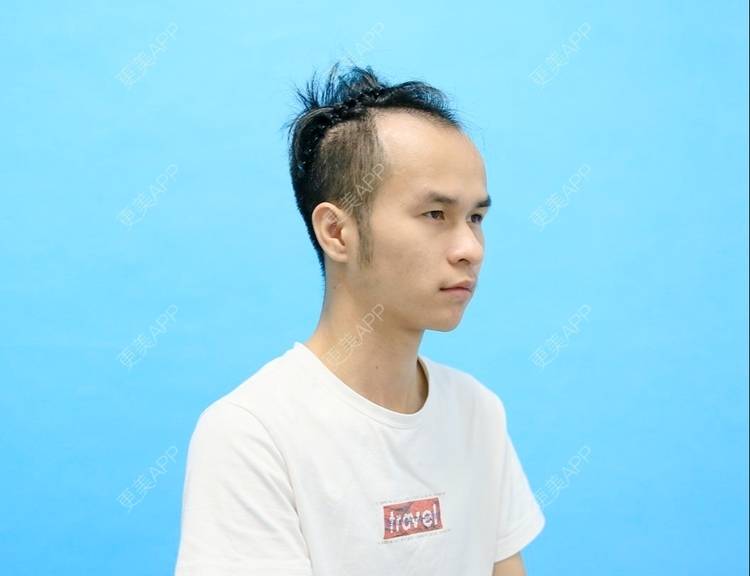 更美 - 更美用户P8KrUHueYa的植发际线经验 | 植发际线 | 毛发移植 | 北京