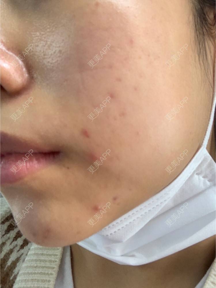 更美 - 更美用户VpFkTnuJED的光子嫩肤经验 | 光子嫩肤 | 上海
