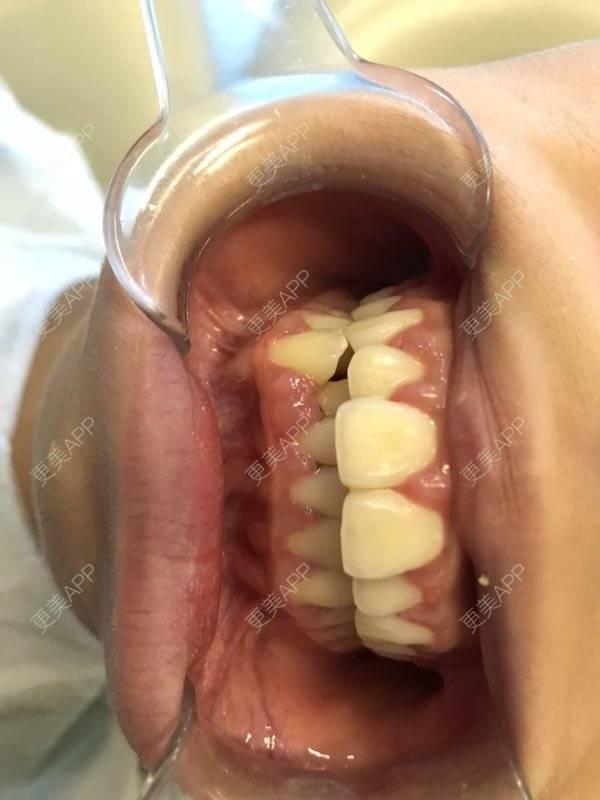 更美 - 更美用户q5tlSx1sWQ的拔智齿经验 | 拔智齿