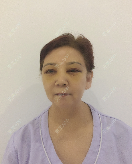 更美 - 更美用户8wVm0OJWxI的外切去眼袋经验 | 外切去眼袋 | 提眉修复 | 郑州