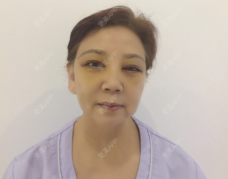 更美 - 更美用户8wVm0OJWxI的外切去眼袋经验 | 外切去眼袋 | 提眉修复 | 郑州