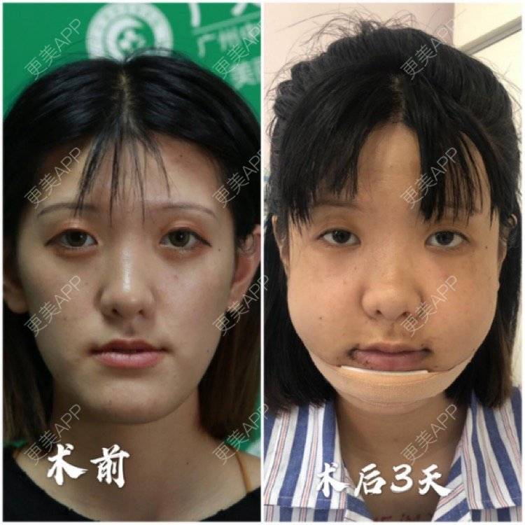 更美用户l8dd8jjw6y的凸嘴矫正日记
