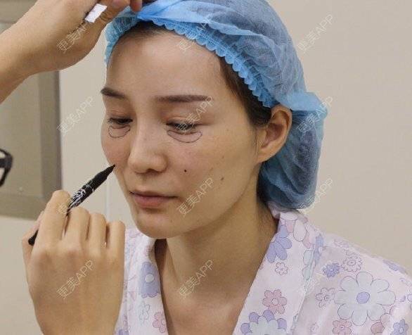 更美 - 更美用户RXnt9GrwIh的祛眼袋经验 | 祛眼袋 | 激光去眼袋 | 祛黑眼圈 | 激光淡化黑眼圈 | 综合去眼袋 | 武汉