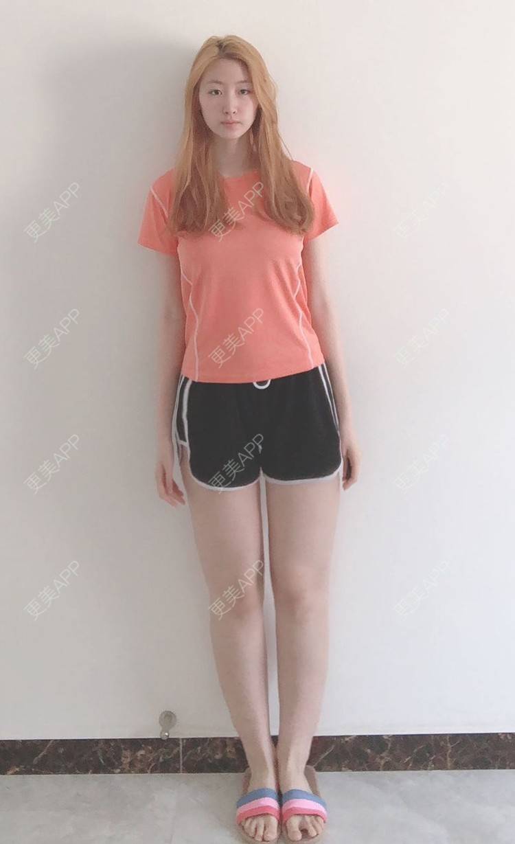 更美 - 巧巧儿🍒的吸脂瘦大腿经验 | 吸脂 | 吸脂瘦大腿 | 南宁