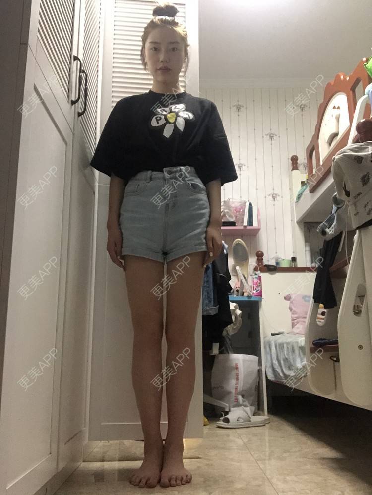 更美 - 十六叶的吸脂瘦大腿经验 | 吸脂 | 吸脂瘦大腿 | 南宁