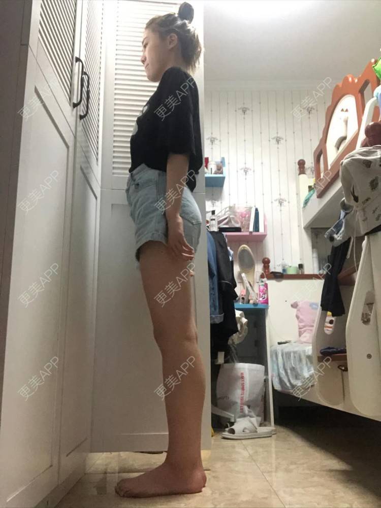 更美 - 十六叶的吸脂瘦大腿经验 | 吸脂 | 吸脂瘦大腿 | 南宁