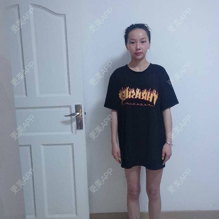 更美 - 心悦月的吸脂瘦大腿经验 | 吸脂 | 吸脂瘦大腿 | 南宁