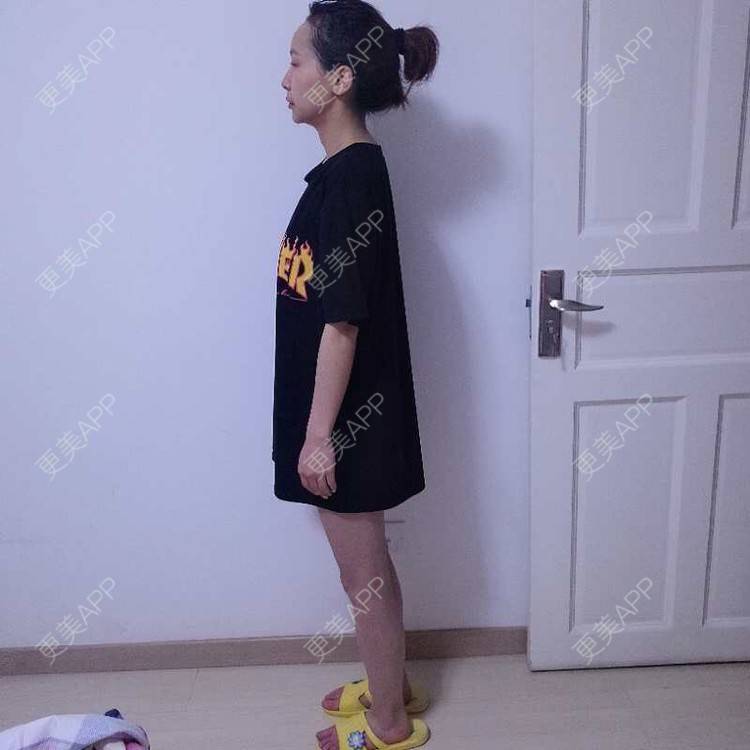 更美 - 心悦月的吸脂瘦大腿经验 | 吸脂 | 吸脂瘦大腿 | 南宁