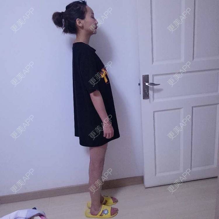 更美 - 心悦月的吸脂瘦大腿经验 | 吸脂 | 吸脂瘦大腿 | 南宁