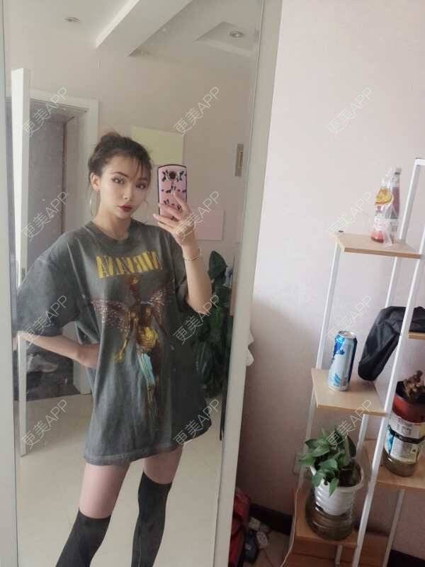 更美 - 心悦月的吸脂瘦大腿经验 | 吸脂瘦大腿 | 南宁 | 吸脂