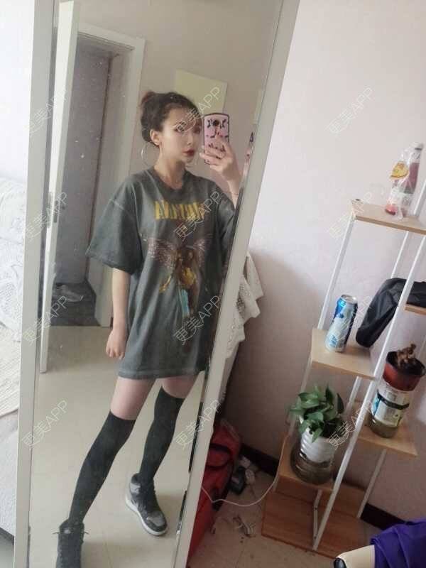 更美 - 心悦月的吸脂瘦大腿经验 | 吸脂瘦大腿 | 南宁 | 吸脂