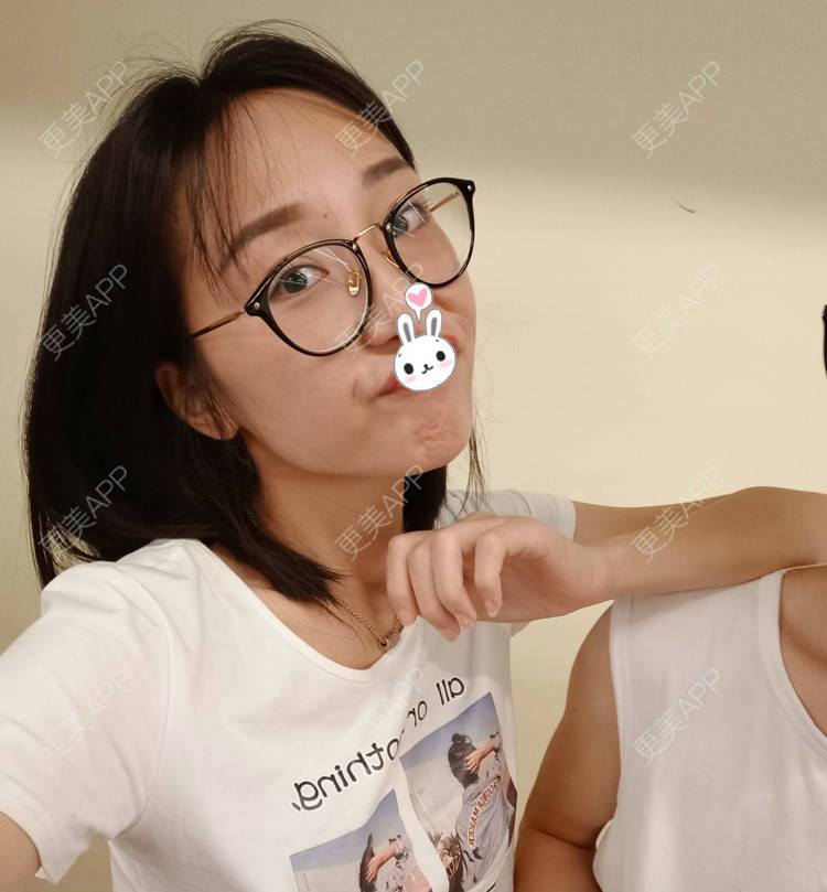 更美 - 更美用户1ieoNiY7aB的植发际线经验 | 北京 | 植发际线 | 毛发移植