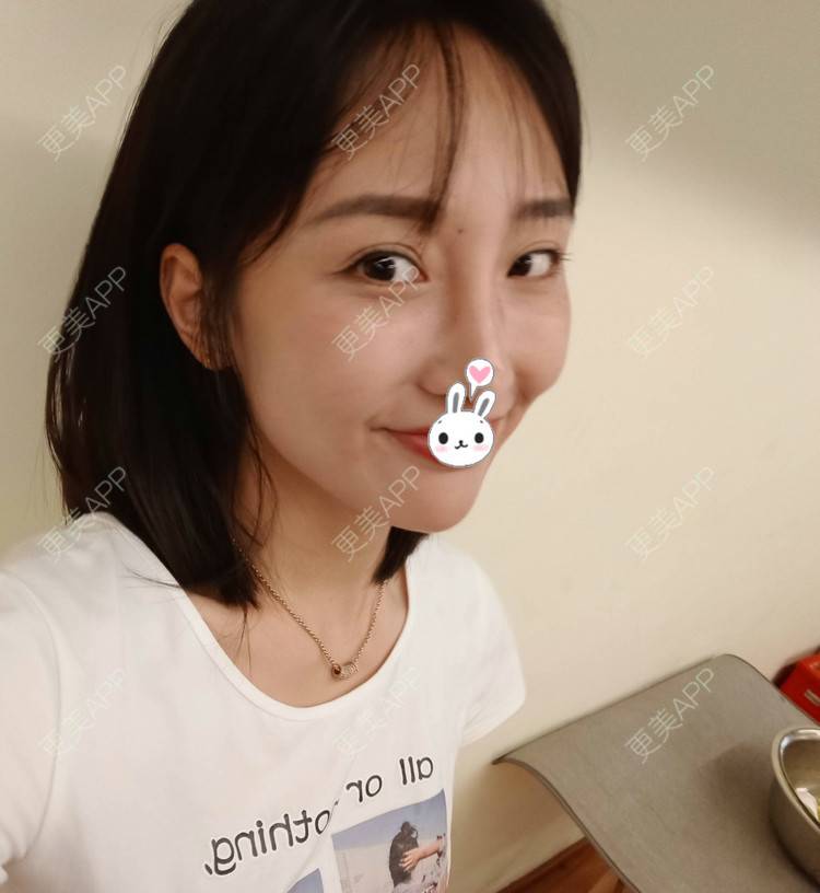 更美 - 更美用户1ieoNiY7aB的植发际线经验 | 北京 | 植发际线 | 毛发移植